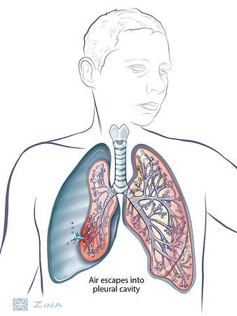 Pneumothorax