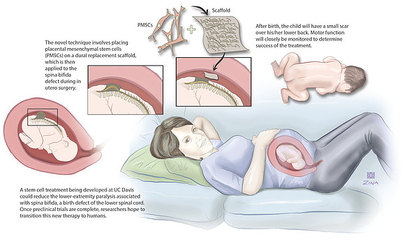 Fetal surgery to correct spina bifida