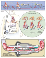 Left Ventricular Assist Device