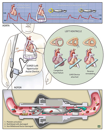 Left Ventricular Assist Device