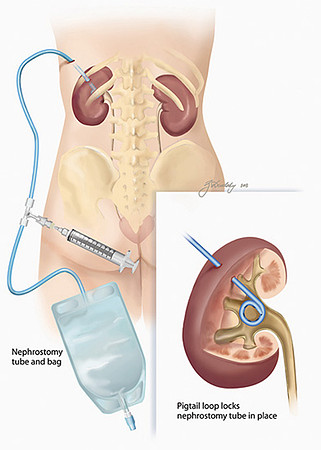 Nephrostomy