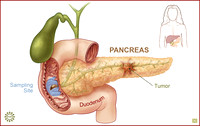 Scanning for Pancreatic Cancer