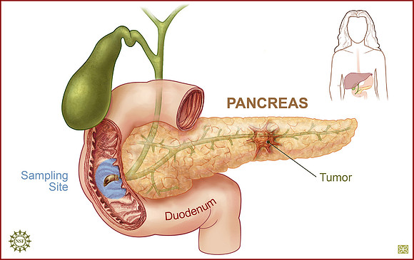 Scanning for Pancreatic Cancer