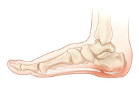 Plantar fasciitis