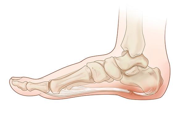 Plantar fasciitis