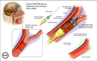 Stroke clot removal mechanism